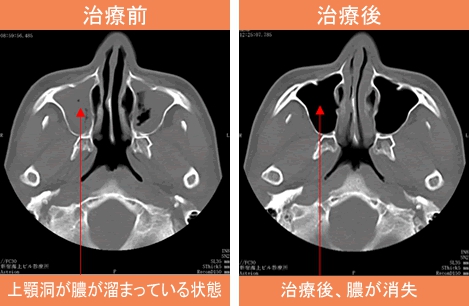 慢性副鼻腔炎CT画像